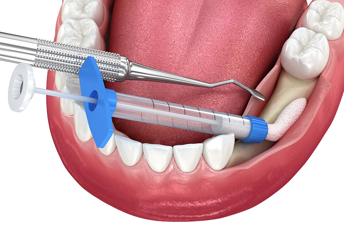 How Does Bone Grafting Work? Dental Implant Center of Rockville