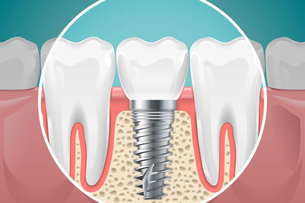 a drawing of a dental implant