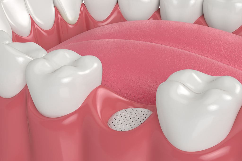 Bone grafting diagram