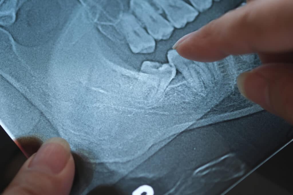 Impacted vs. Erupted Wisdom Teeth: Understanding Your Wisdom Tooth Removal Options
