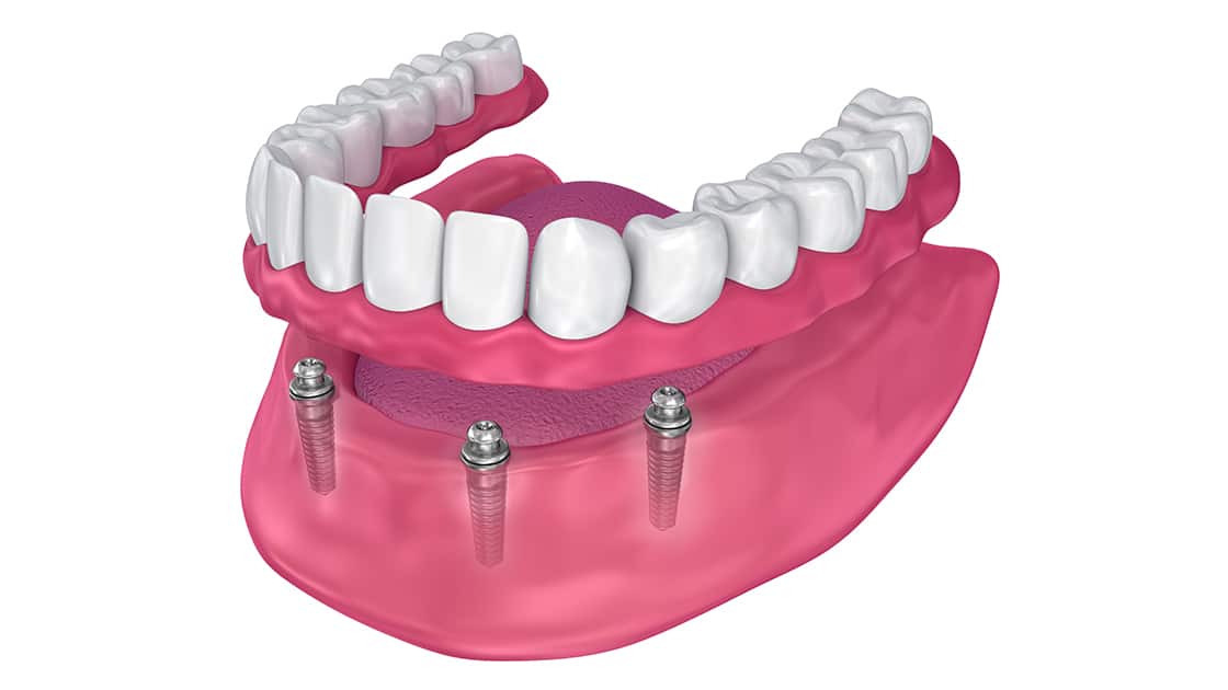 Mini Dental Implants Photo