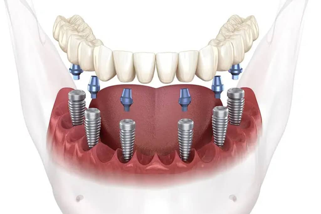 What Makes a Good Candidate for Full Arch Restorations in Rockville?
