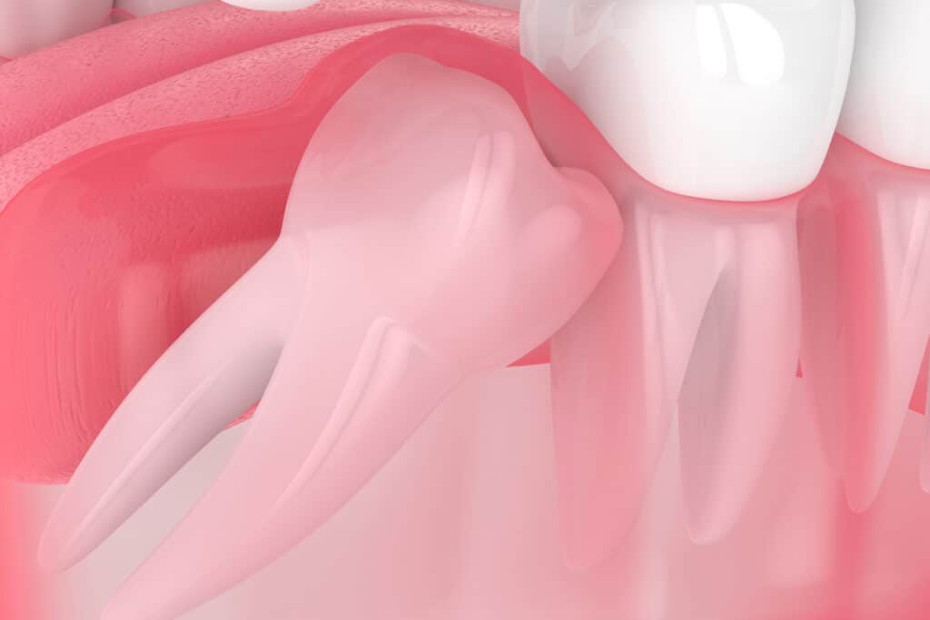 Wisdom Tooth Recovery: What to Expect After Your Extraction